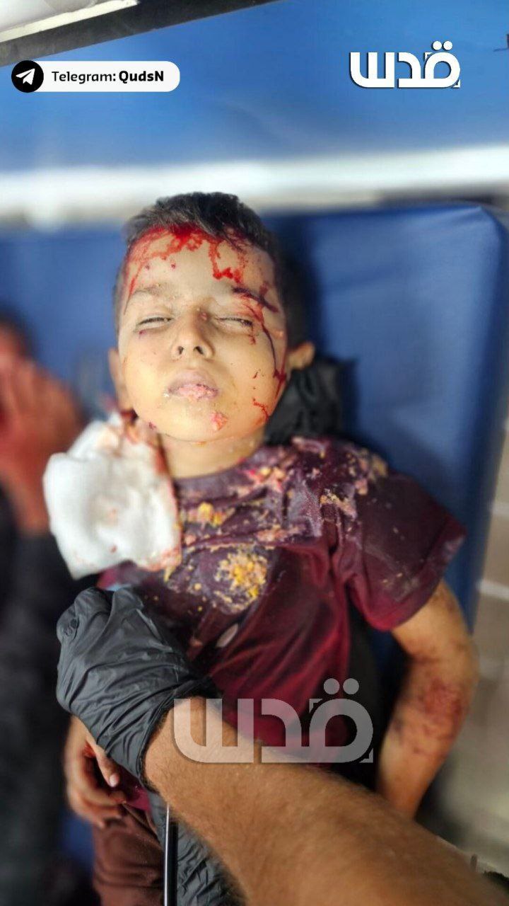 🔴 بينما كان يتناول الطعام.. طفلٌ أصيب إثر قصف طيران…