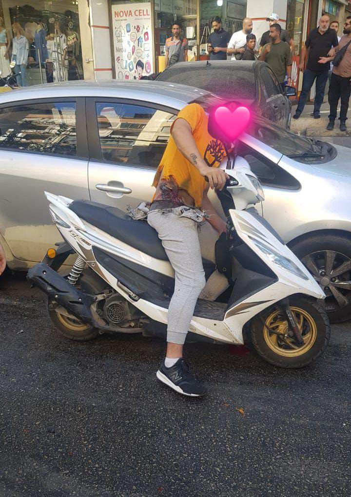 صورة لإحدى الإصابات بعد اختراق الأجهزة اللاسلكية “بيجر” في لبنان