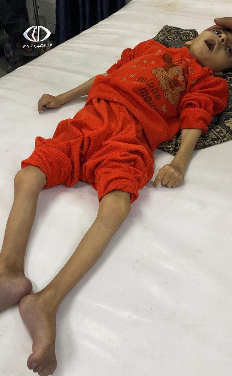 وزارة الصحة بغزة: استشهاد الطفل مصطفى ياسين بسبب سوء التغذية…