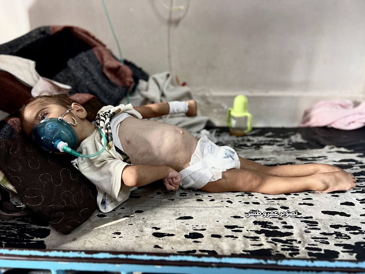 الطفلة مريم أبو مصطفى  تصارع الموت في غزة نتيجة…