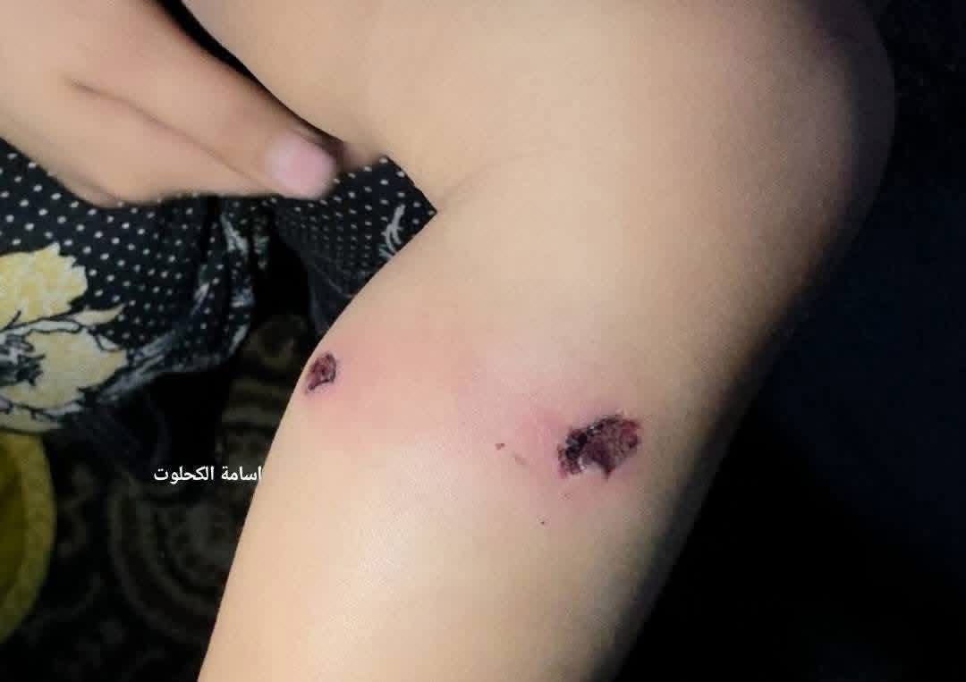 “أعقاب سجائر وأداة حادة تُستخدم لتعذيبه في قدمه”..
عناصر من الجيش…