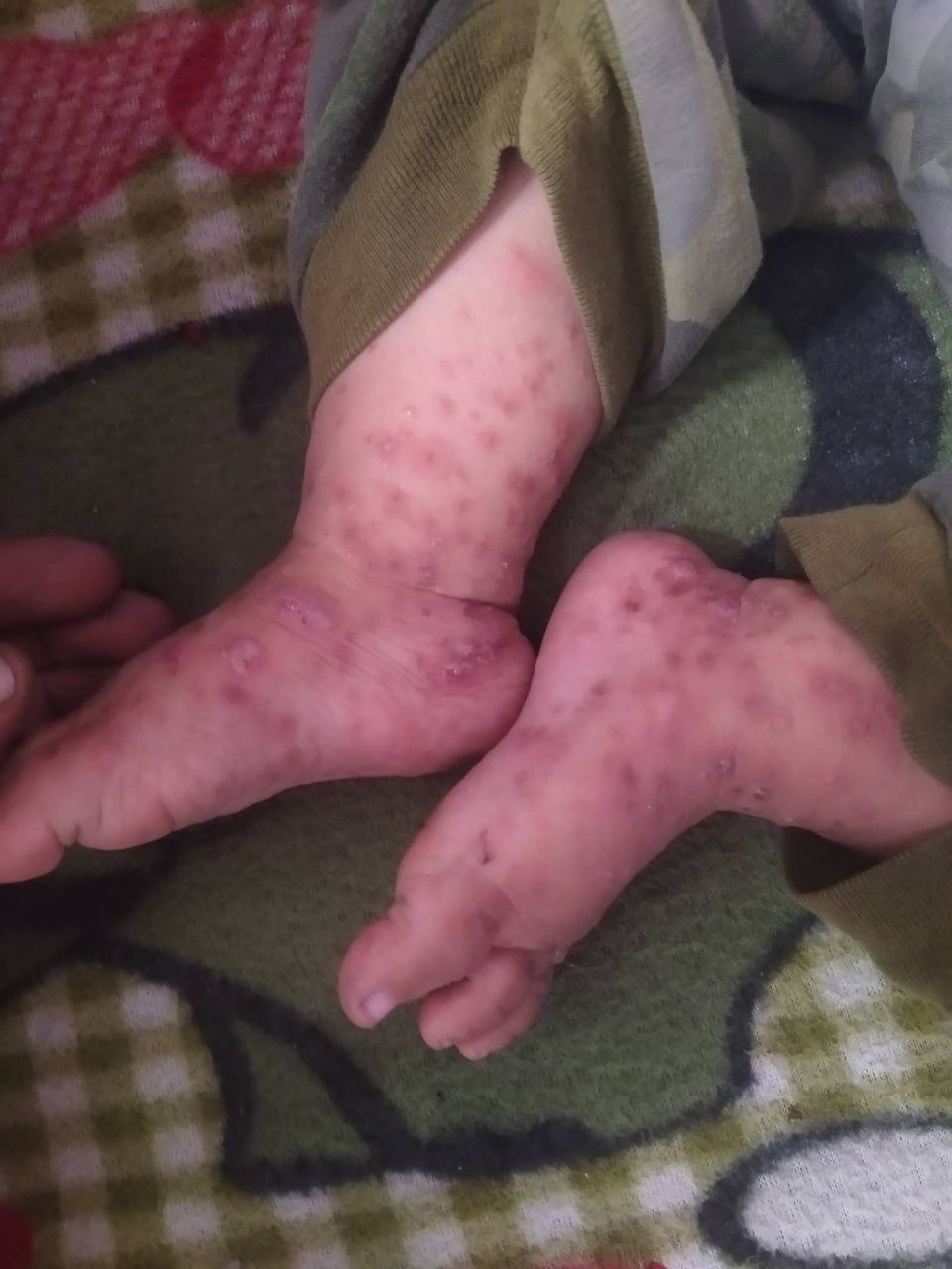 غزة.. الأمراض الجلدية تنتشر بقسوة في أوساط الأطفال في ظل…